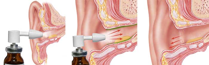 Schematische Anwendung des LipoNit® Ohrensprays